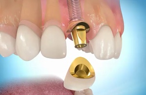 Сколько стоит имплантация зубов?
