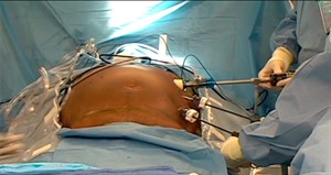 Распространенные хирургические операции: удаление грыжи белой линии живота, баллонирование желудка