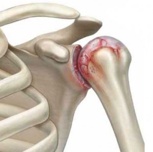 Артроз плечевого сустава – методы борьбы с патологией